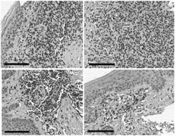 CCR4-Targeting Chimeric Antigen Receptor Cell Therapy