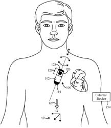 Implantable medical device for arrhythmia detection