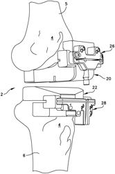 PATIENT SPECIFIC SURGICAL GUIDE LOCATOR AND MOUNT