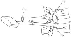 Facet Fusion Tube Assembly