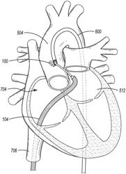 Methods and devices for creation of communication between aorta and left atrium