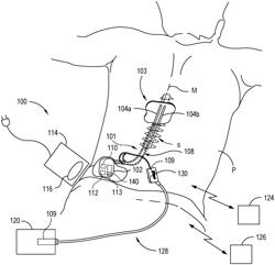 Neurostimulation for treating sensory deficits, and associated systems and methods