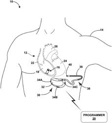 SYSTEMS AND METHODS FOR LEADLESS PACING AND SHOCK THERAPY