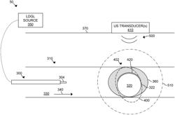 System and Method for Acoustic Treatment Using Targeted Placement of Low Dissolved Gas Liquids