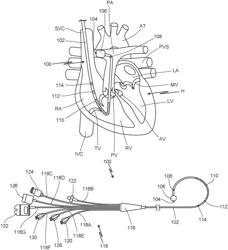 SYSTEM FOR PREVENTING CATHETER BALLOON HYPERINFLATION