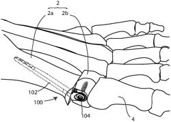 Bunion correction system and method