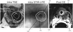 System for and method of temperature-sensitive frozen tissue imaging for cryoablation monitoring