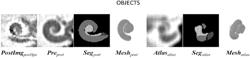 METHODS OF AUTOMATIC SEGMENTATION OF ANATOMY IN ARTIFACT AFFECTED CT IMAGES WITH DEEP NEURAL NETWORKS AND APPLICATIONS OF SAME