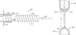 Esophageal atresia bridge device and methods of treating esophageal atresia