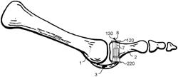 IMPLANT DEVICE FOR PLANTAR REPAIR