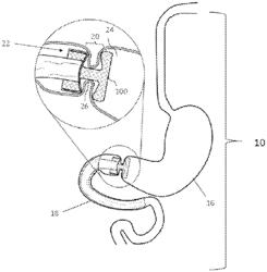 SYSTEMS AND MEHTODS FOR STABILIZING ANTI-MIGRATION ANCHOR SYSTEM