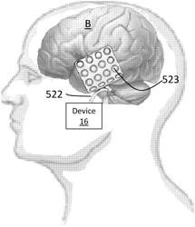 Method and apparatus for improving cognitive performance through cortical stimulation