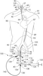 Systems and methods for retrograde perfusion and clearance of emboli