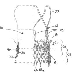 IMPROVEMENTS RELATING TO TRANSCATHETER STENT-VALVES