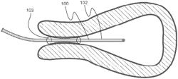 MINIMALLY INVASIVE ACCESS CHANNELS INTO BODILY REGIONS