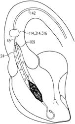 CURVATURE OF VENTRICULAR ASSIST DEVICE