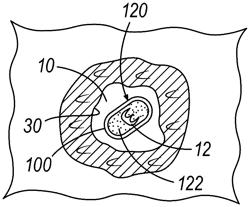 BIOPSY SITE MARKER FOR LIMITED MIGRATION