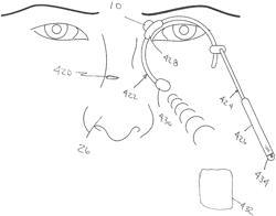 Device configured to position a sensor at an Abreu brain thermal tunnel terminus