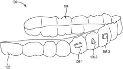 DENTAL APPLIANCE ETCH TEMPLATE