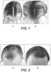 FORMULATION FOR INCREASING HAIR GROWTH AND REDUCING HAIR THINNING