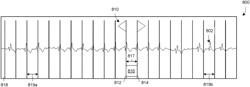 Electronic electrocardiogram calipers