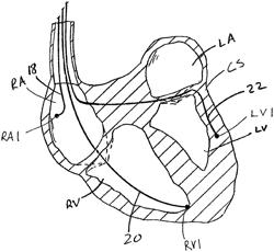 Summation anodal pacing to complement multisite stimulation