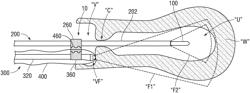 DEVICES AND SYSTEMS FOR ULTRASOUND GUIDED ENDOSCOPIC SURGICAL PROCEDURES