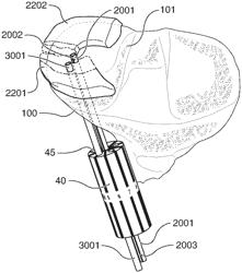 Methods and devices for attaching or reattaching soft tissue to bone