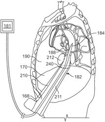 Diaphragm entry for posterior surgical access