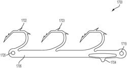 Devices and methods for the treatment of heart valve insufficiencies