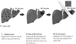 RF microchip for induction of cancer cells migration for radio frequency thermal therapy for cancer treatment or removal surgery