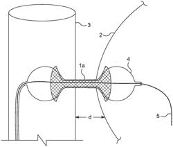 ENDOLEAK DEVICE