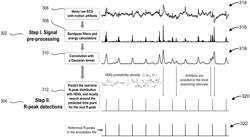 SYSTEM AND METHOD FOR PROBABILISTIC SEARCH FOR R-PEAK DETECTION FROM ELECTROCARDIOGRAM