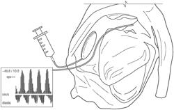 Device and method for diagnosis of cardiac tamponade