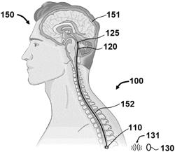 CORTICAL SUBARACHNOID AND INTRAVENTRICULAR BRAIN INTERFACES