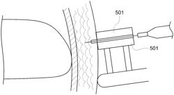 Transperineal prostate biopsy and treatment methods