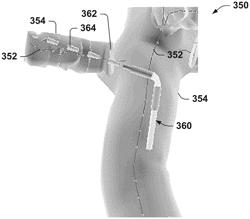 METHOD AND SYSTEM TO FACILITATE INTRAOPERATIVE POSITIONING AND GUIDANCE